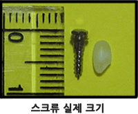 치아교정스크류1.jpg