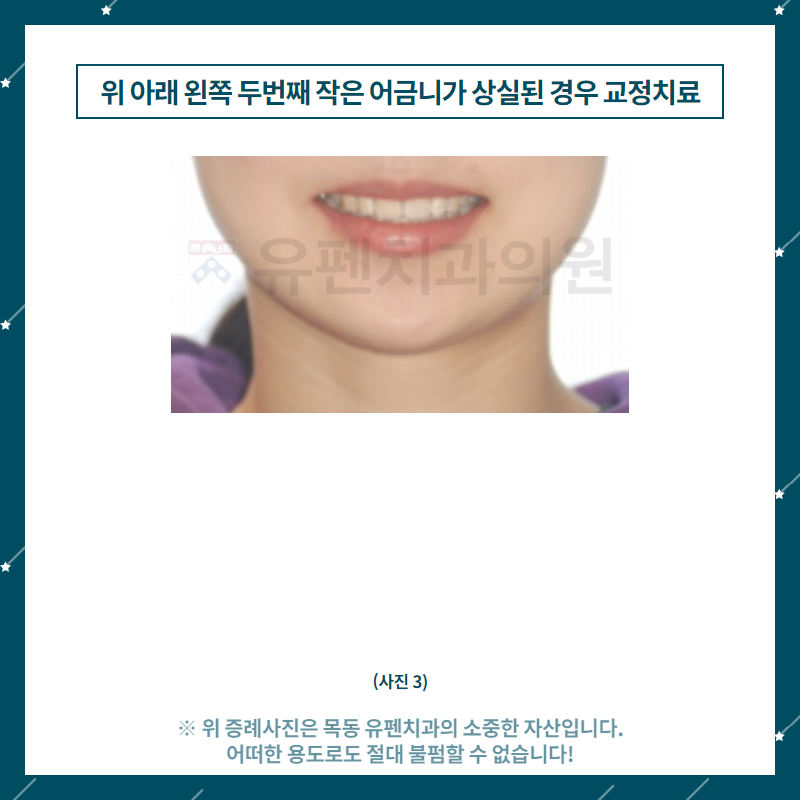 5목동유펜치과_위_아래_왼쪽_두_번째_작은_어금니가_상실된_경우의_.png