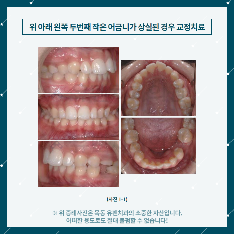 2목동유펜치과_위_아래_왼쪽_두_번째_작은_어금니가_상실된_경우의_.png