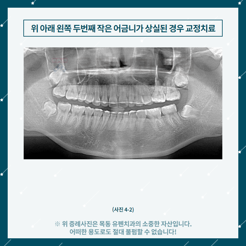 7목동유펜치과_위_아래_왼쪽_두_번째_작은_어금니가_상실된_경우의_.png
