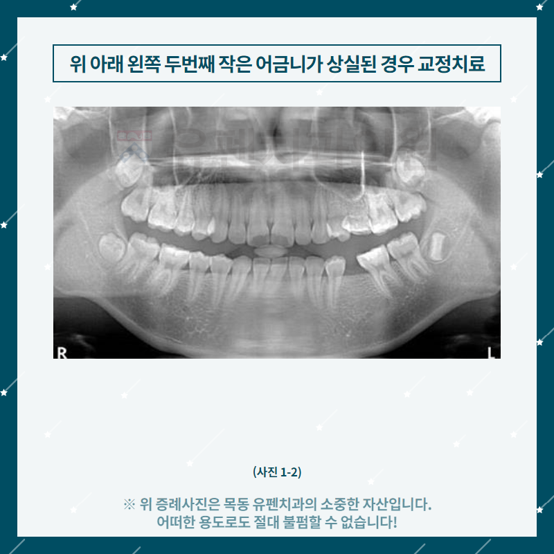 3목동유펜치과_위_아래_왼쪽_두_번째_작은_어금니가_상실된_경우의_.png