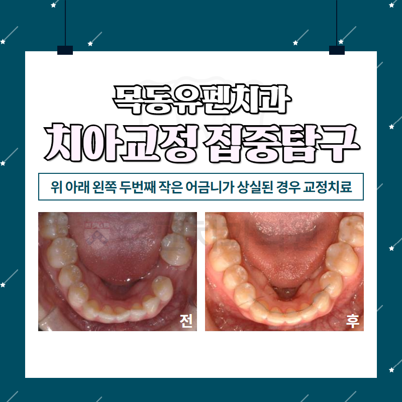 1목동유펜치과_위_아래_왼쪽_두_번째_작은_어금니가_상실된_경우의_.png
