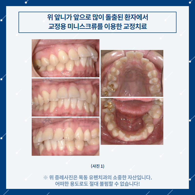 오목교교정치과_유펜치과_돌출된_위_앞니의_교정치료_02.png