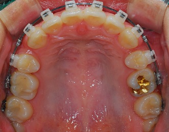 오라픽스 치아교정 포스팅(5).jpg