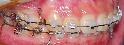 오라픽스 치아교정 포스팅(3).jpg