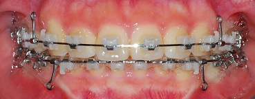 오라픽스 치아교정 포스팅(1).jpg