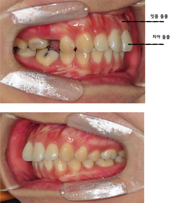 치아교정후기4.jpg