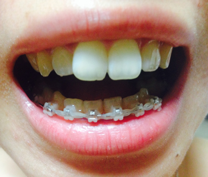 치아교정후기05.JPG