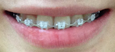 치아교정후기1.jpg