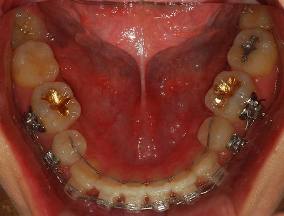 오라픽스 치아교정 포스팅(3).jpg
