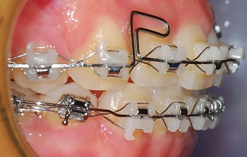 오라픽스 치아교정 포스팅(1).jpg