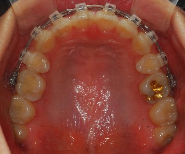 오라픽스 치아교정 포스팅(2).jpg