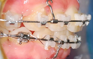 오라픽스 치아 교정 포스팅 사진 (3).jpg