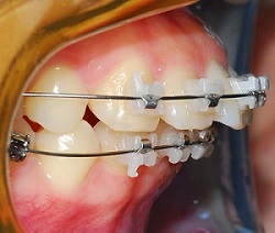 오라픽스 치아 교정 포스팅 사진 (1).jpg
