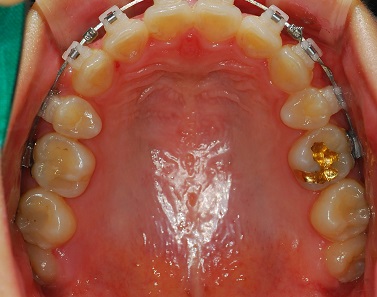 오라픽스 치아 교정 포스팅 사진 (4).jpg