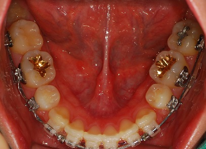 오라픽스 치아 교정 포스팅 사진 (5).jpg