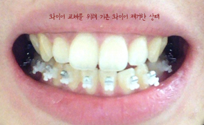치아교정후기04.JPG