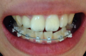 치아교정후기06.JPG