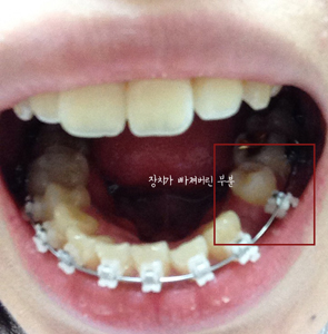치아교정후기01.JPG