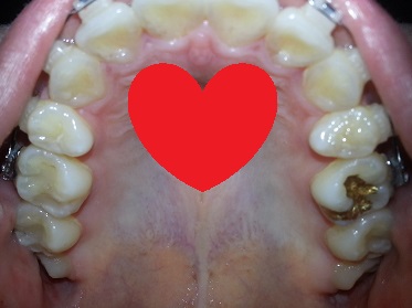 오라픽스 치아교정 포스팅(4).jpg