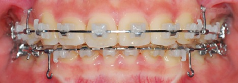 오라픽스 치아 교정 포스팅 (9).jpg