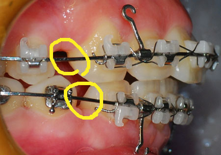 오라픽스 치아 교정 포스팅 (4).jpg