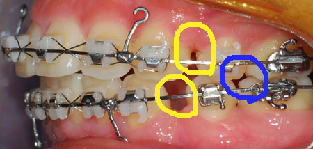 오라픽스 치아 교정 포스팅 (5).jpg