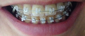 치아교정후기6.jpg