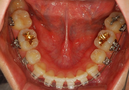 오라픽스 치아교정 포스팅(2).JPG