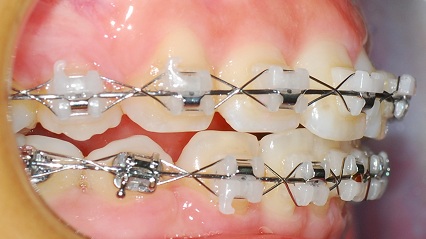 오라픽스 치아교정 포스팅(5).JPG