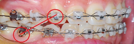 오라픽스 치아교정 포스팅(6).JPG