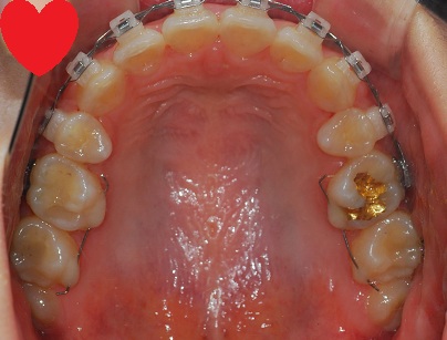 오라픽스 치아교정 포스팅(1).JPG