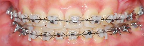 오라픽스 치아교정 포스팅(4).JPG