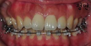치아교정후기1.jpg
