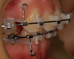 오라픽스 치아교정 포스팅(3).JPG