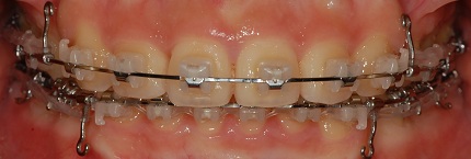 오라픽스 치아교정 포스팅(2).JPG