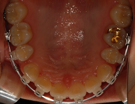 오라픽스 치아교정 포스팅(4).JPG