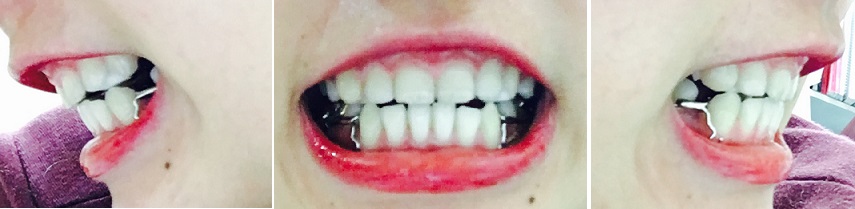 교정후기 21_1.jpg