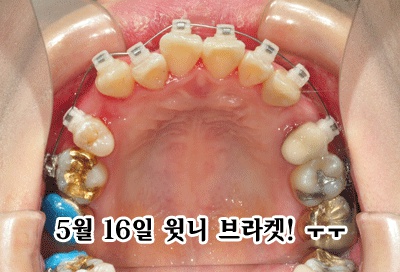 0516-윗니.jpg