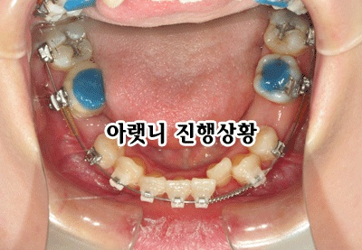 0516-아랫니.jpg