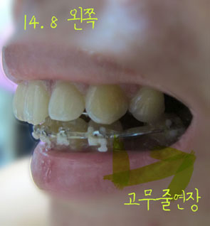 치아교정후기04.jpg