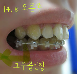 치아교정후기03.jpg