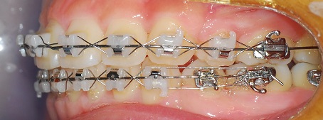 오라픽스 치아교정 포스팅(1).JPG