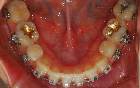 오라픽스 치아교정 포스팅(3).JPG