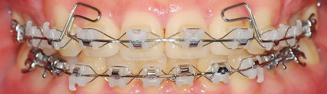 오라픽스 치아교정 포스팅 (6).jpg