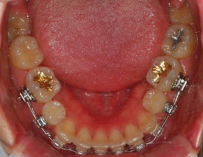 오라픽스 치아교정 포스팅 (8).jpg