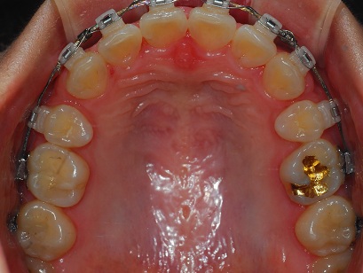 오라픽스 치아교정 (2).jpg