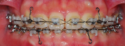오라픽스 치아교정 (1).jpg