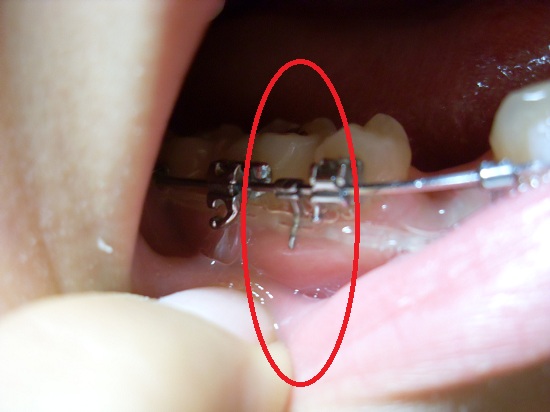 오라픽스 치아교정 포스팅(4).JPG