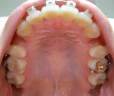 오라픽스 치아교정 포스팅(9).JPG